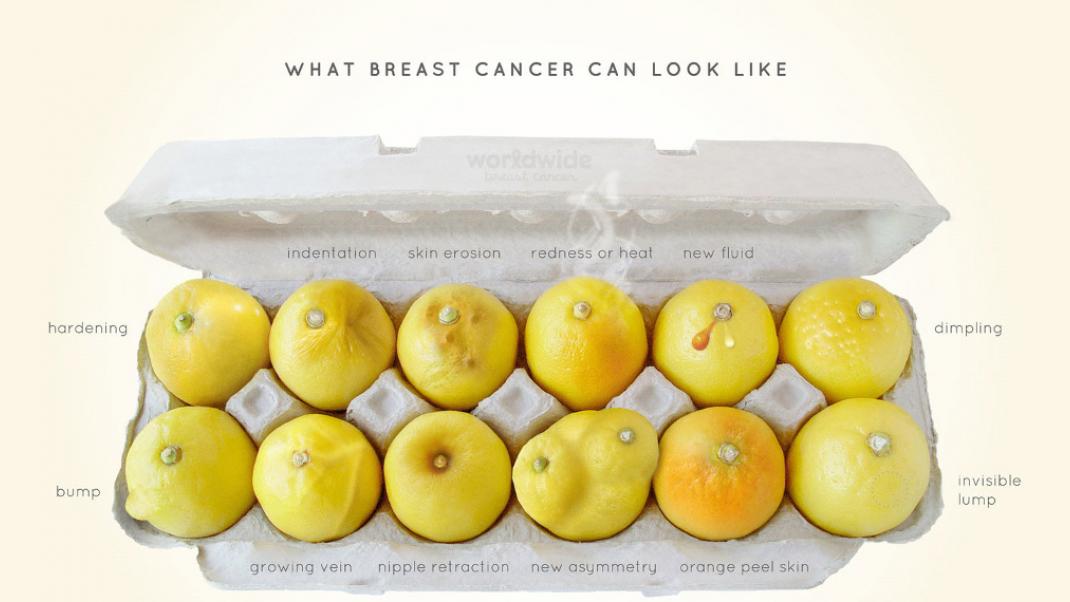 Εσύ πόσο καλά ξέρεις τα «λεμόνια σου»; -Η αφίσα που δείχνει πώς μοιάζει ο καρκίνος του μαστού | 0 bovary.gr