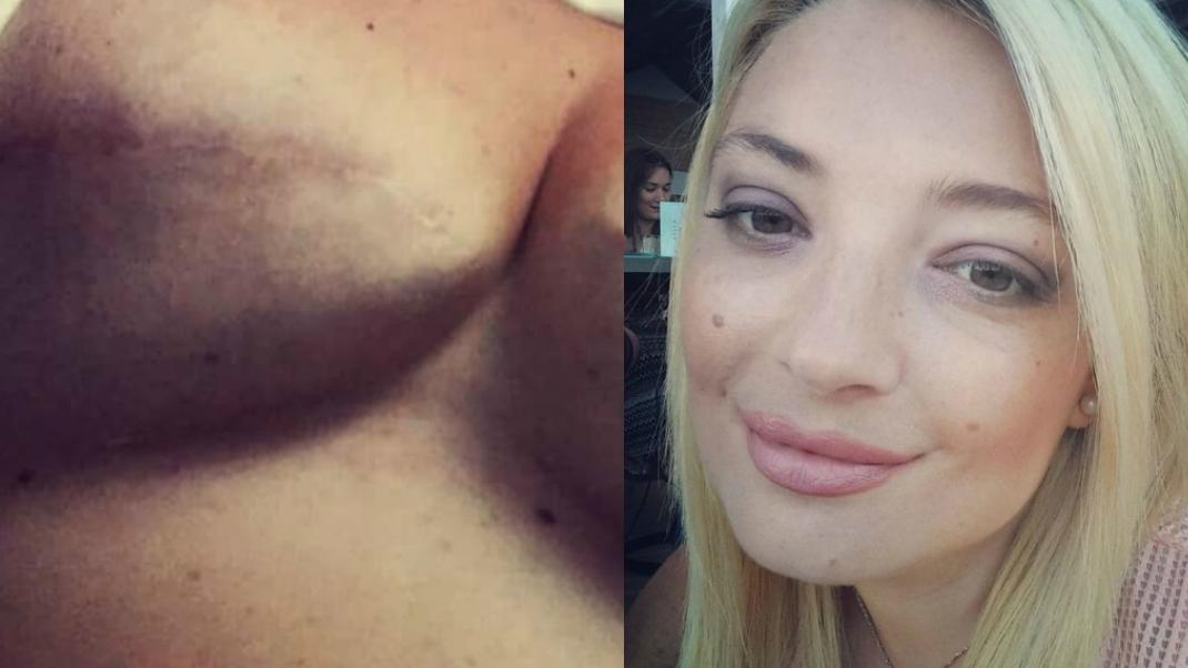 Η Ελληνίδα που νίκησε τον καρκίνο δείχνει τη διπλή μαστεκτομή της στο Facebook για να αφυπνίσει τις γυναίκες  | 0 bovary.gr