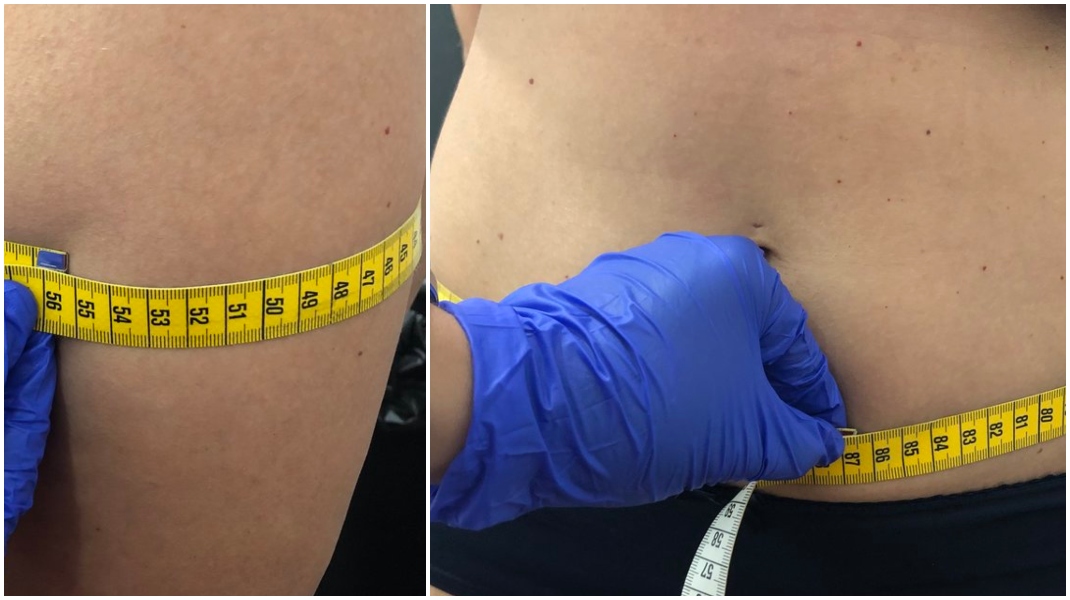 Έκανα vaser shape και μέσα σε μισή ώρα έχασα πόντους από την κοιλιά και