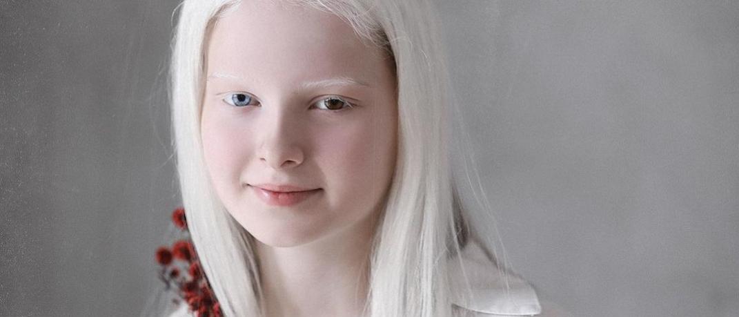 To 11χρονο κορίτσι με την σπάνια ομορφιά
