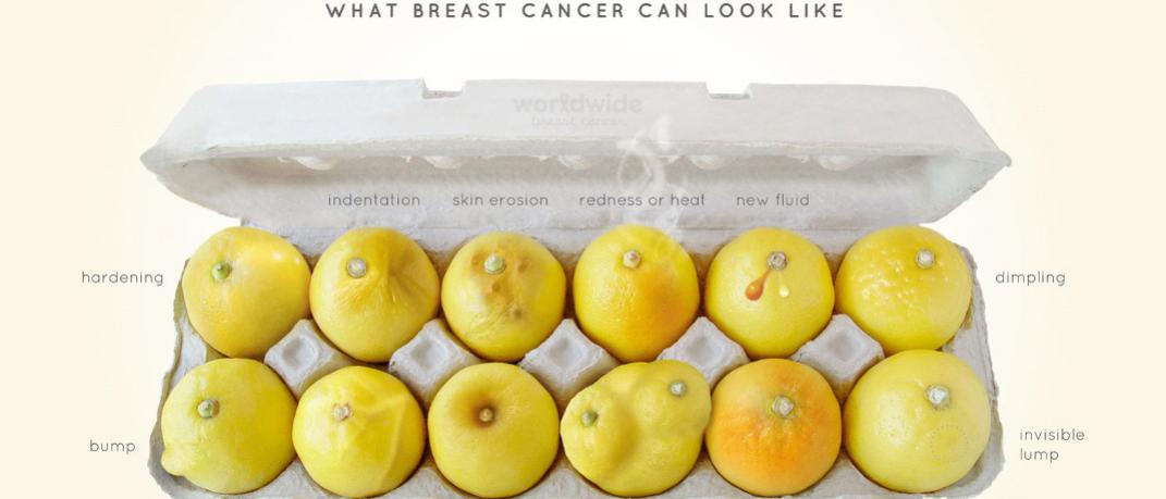 Εσύ πόσο καλά ξέρεις τα «λεμόνια σου»; -Η αφίσα που δείχνει πώς μοιάζει ο καρκίνος του μαστού | 0 bovary.gr