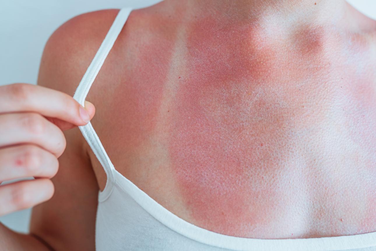 Δεν πρέπει να χρησιμοποιείτε την Nivea για ανακούφιση από το ηλιακό έγκαυμα/Φωτογραφία: Shutterstock 