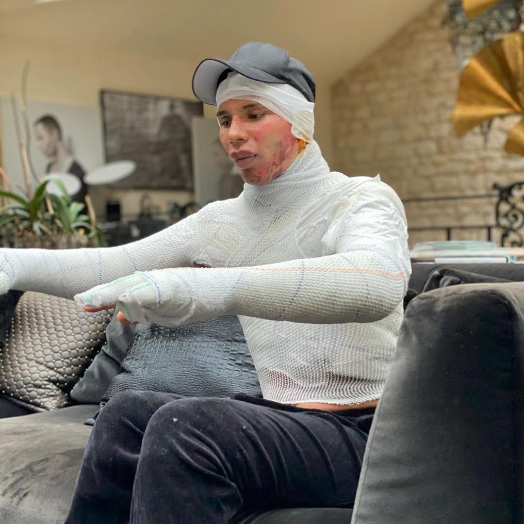 Ο Olivier Rousteing μετά το ατύχημά του/Φωτογραφία: Instagram/olivier_rousteing