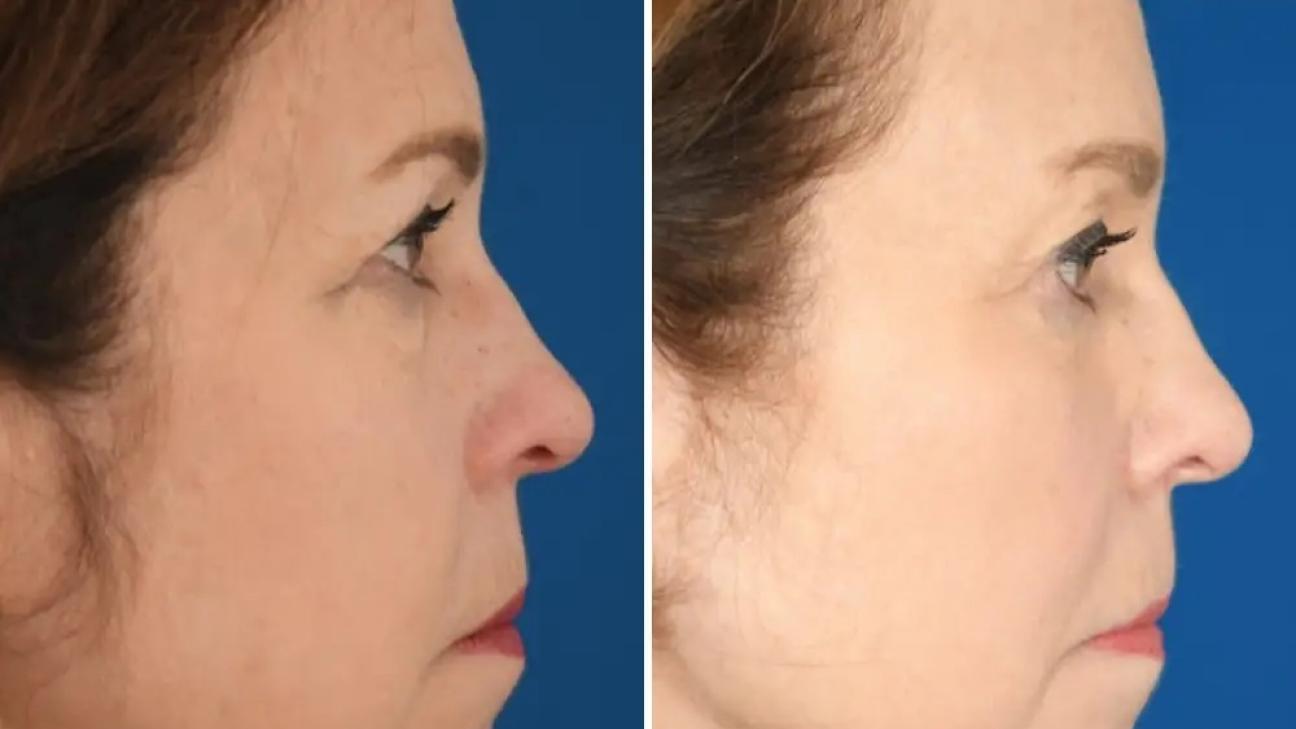 Έχω ξοδέψει 33.000 δολάρια σε αισθητικές επεμβάσεις στα 65 μου. Μου έχει αλλάξει τη ζωή στην καριέρα και την αυτοπεποίθησή μου