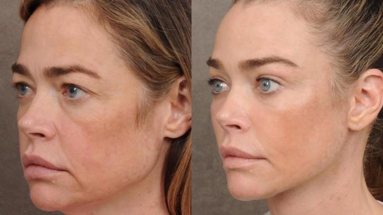 Πλαστική χειρουργική - Φωτογραφία Instagram/Denise Richards