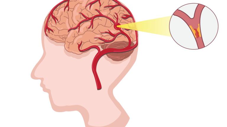 Ισχαιμικό ή αιμορραγικό εγκεφαλικό: Πώς θα το αναγνωρίσετε και σε τι διαφέρουν -Τι λέει καθηγητής Νευρολογίας