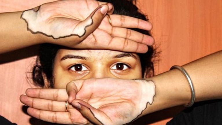 Ανθρώπινος καμβάς -Γυναίκα με λεύκη μεταμορφώνει τα σημάδια της σε έργα τέχνης | 0 bovary.gr