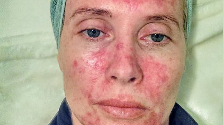 «Πώς η ηλιοθεραπεία στην Κρήτη μού κατέστρεψε το πρόσωπο»: Οι selfies τουρίστριας  | 0 bovary.gr