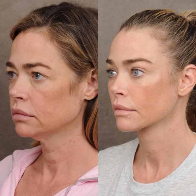 Πλαστική χειρουργική - Φωτογραφία Instagram/Denise Richards