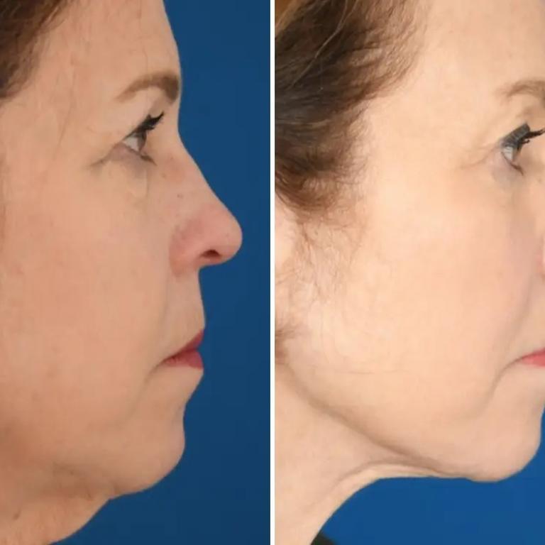 Πριν και μετά το λίφτινγκ/ Φωτογραφία: Courtesy of Dr. Kwak