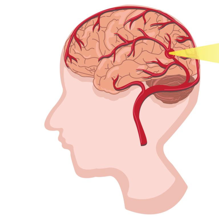 Ισχαιμικό ή αιμορραγικό εγκεφαλικό: Πώς θα το αναγνωρίσετε και σε τι διαφέρουν -Τι λέει καθηγητής Νευρολογίας